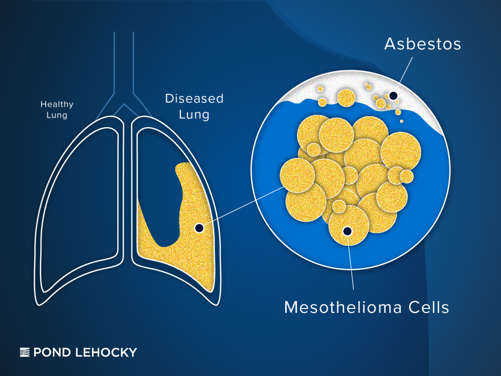 Legal Claims for Mesothelioma and Lung Cancer From Asbestos Exposure