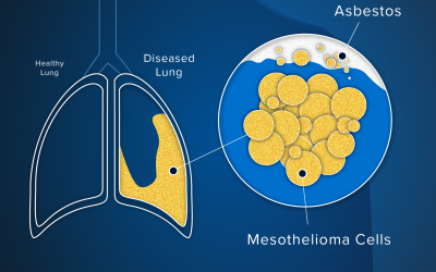 Legal Claims for Mesothelioma and Lung Cancer From Asbestos Exposure