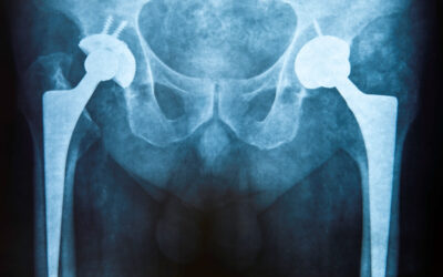 Demandas por prótesis de cadera de metal sobre metal: Cuándo llamar a un abogado especializado en metalosis